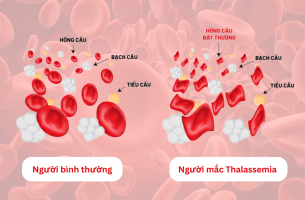 Thalassemia Là Gì? Hiểu Đúng Để Đồng Hành Cùng Hành Trình Điều Trị